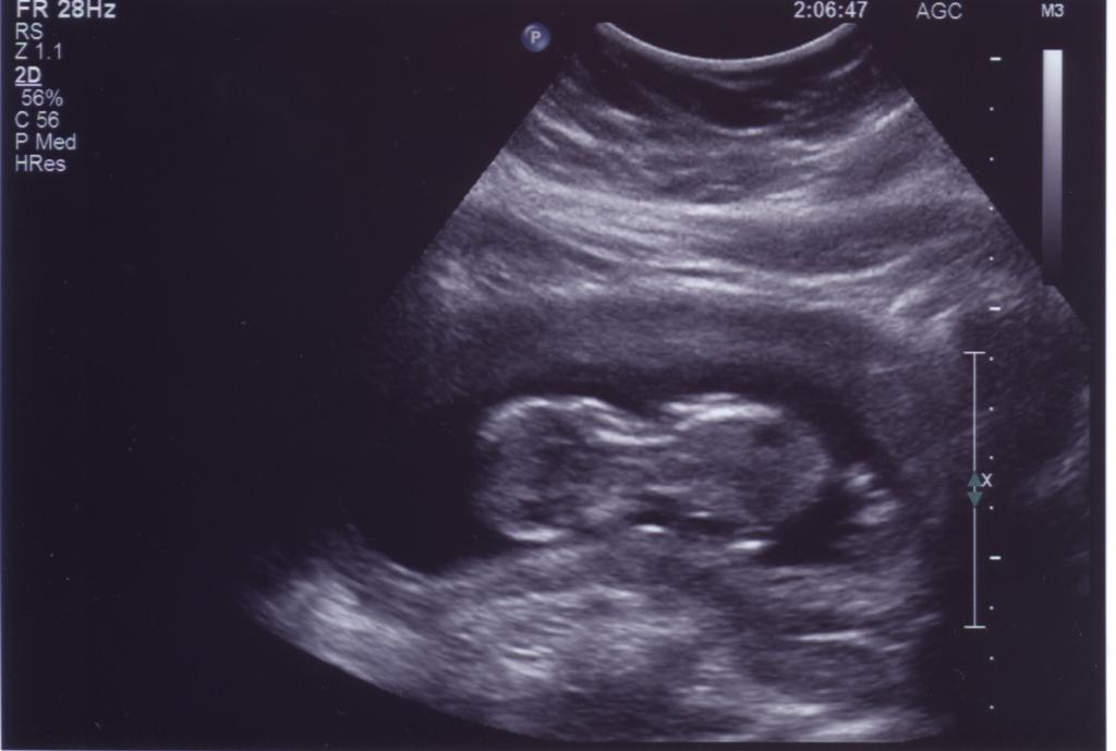 September 28th Ultrasound pic 1 of 4