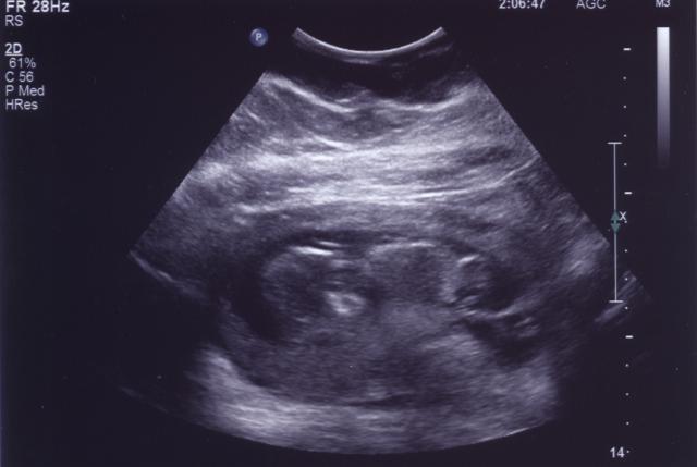 September 28th Ultrasound pic 2 of 4