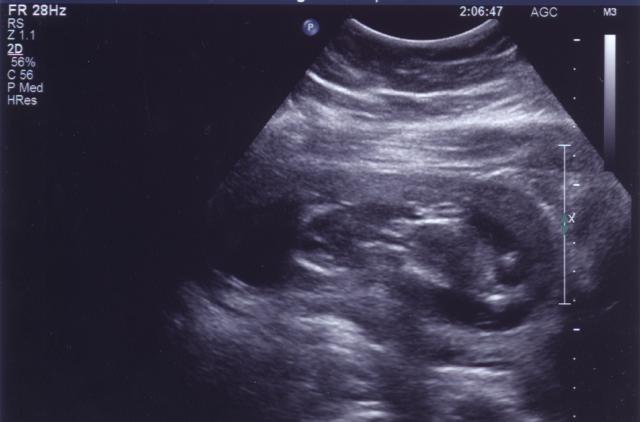 September 28th Ultrasound pic 3 of 4