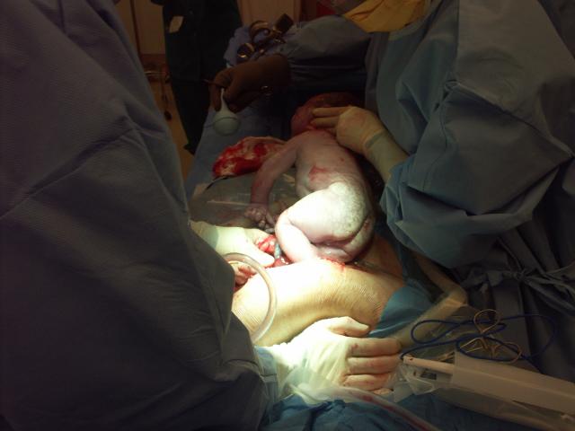 Being Born via C-Section
